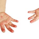 Impetigo Pictures: 3 Stages You Should Know: Early, Mild, and Severe impetigo symptoms